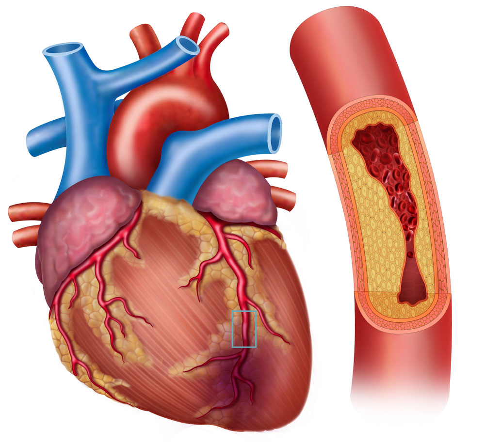อาการแบบไหนเสี่ยงเส้นเลือดหัวใจตีบ