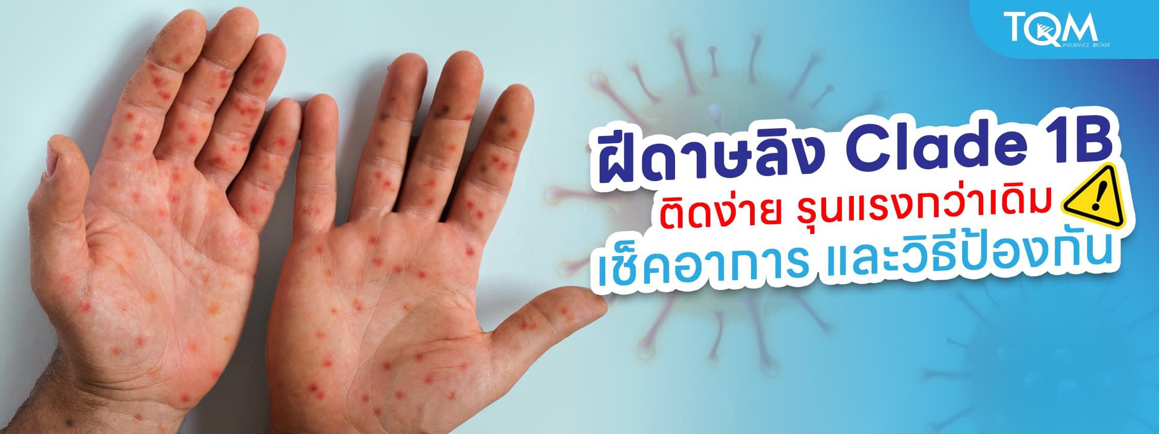 ทำความรู้จักฝีดาษลิง Clade 1B ติดต่อง่ายรุนแรงกว่าเดิม